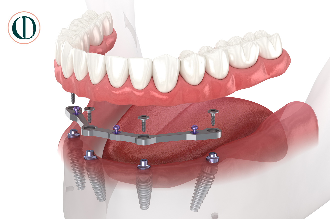 dentalimplant-dentures