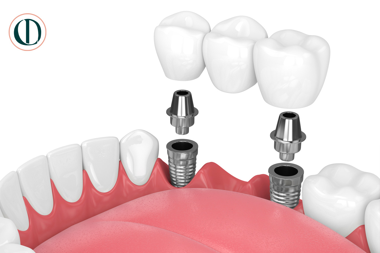dentalimplant-multiple