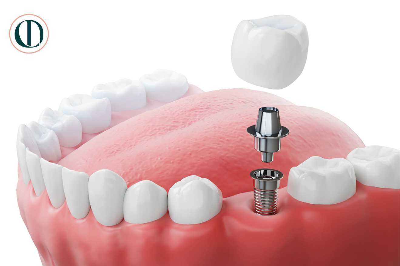 dentalimplant-single