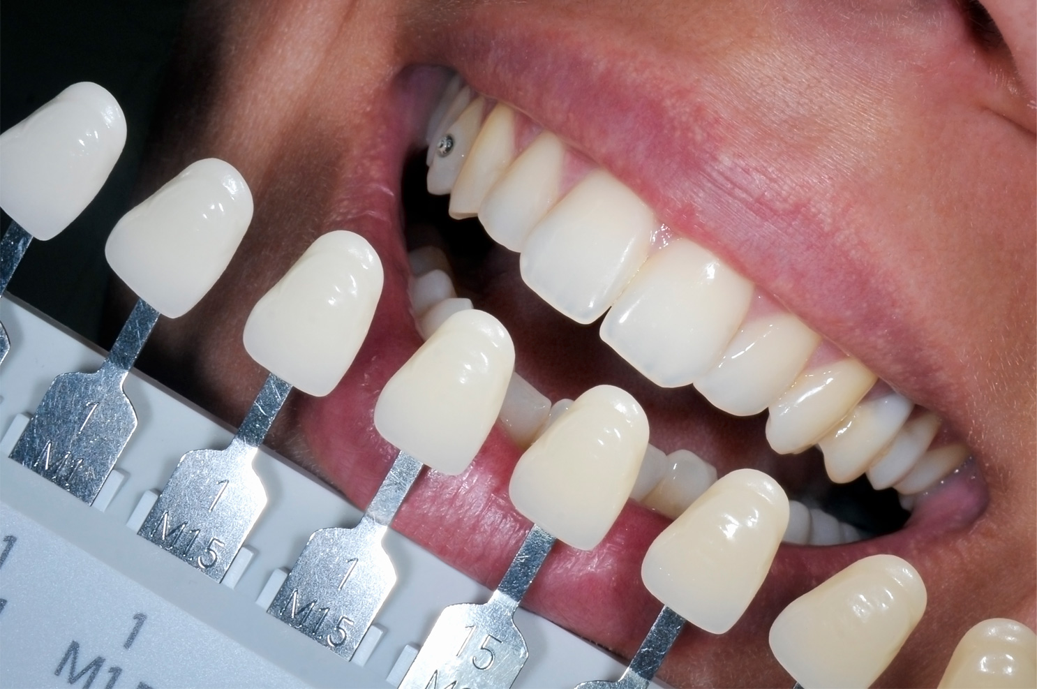 tooth-whitening