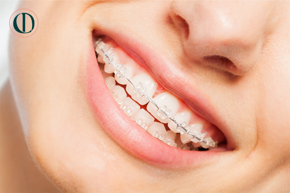 fixedbraces2