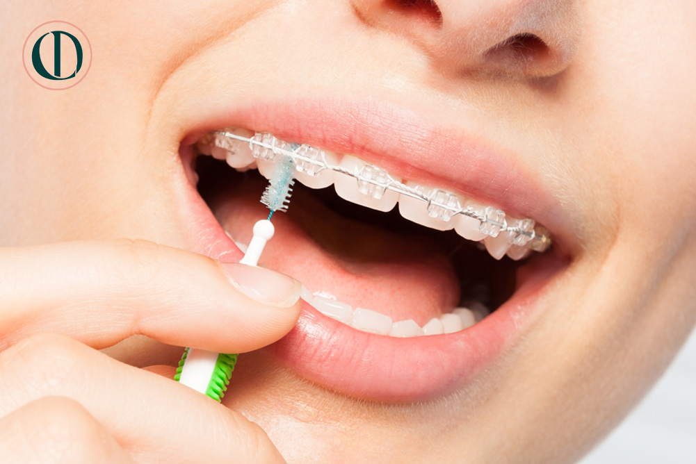 fixedbraces3